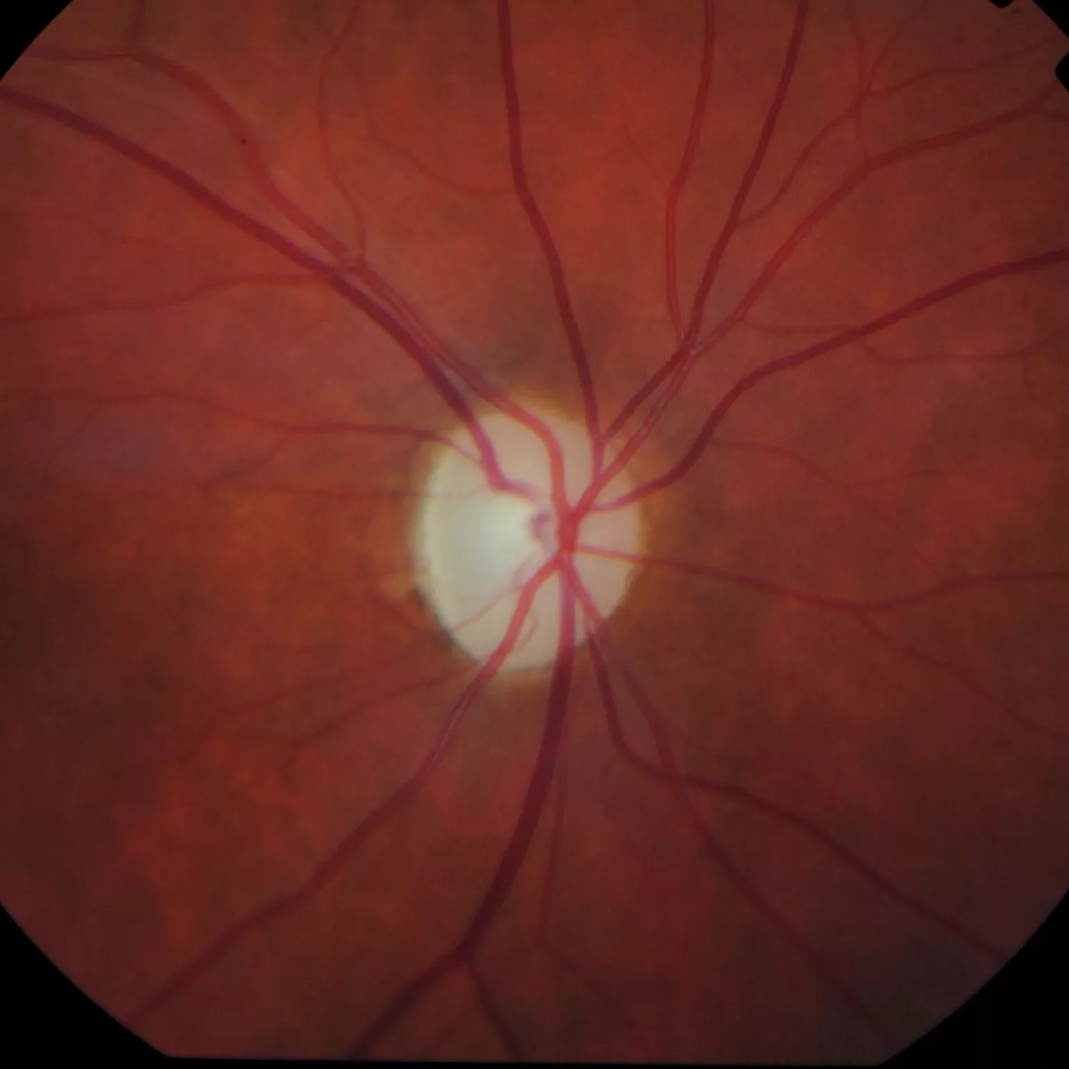 Photograph of blood vessels in an eye